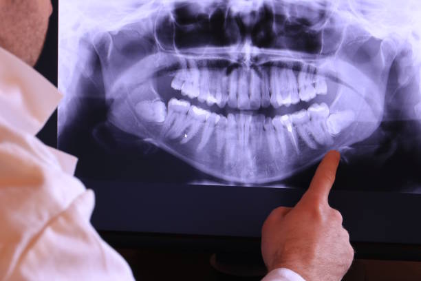 Best Emergency Wisdom Teeth Removal in Woodburn, OR