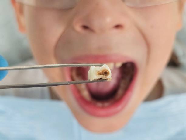 Best Emergency Treatment for Toothache in Woodburn, OR
